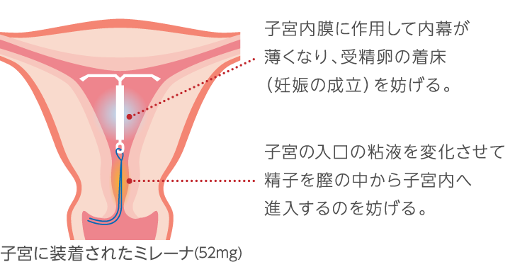 どの避妊が自分に適しているかを決定する