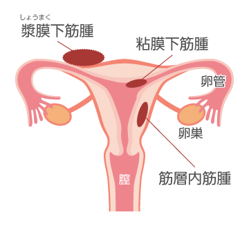 子宮筋腫の種類・部位